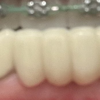 Long Beach Dental Group - Discolored Too big/tall Not my teeth from my impressions Sliver showing Bad dental bridge - General Dentistry Near Me - Long Beach, California Long Beach Dental Group - Discolored Too big/tall Not my teeth from my impressions Sliver showing Bad dental bridge - General Dentistry Near Me - Long Beach, California