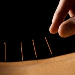 Winchester Acupuncture Clinic - Acupuncture