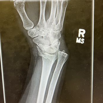 High Desert Orthopedics - x-ray from when I broke my wrist - Physical Therapy Near Me - Apple Valley, California