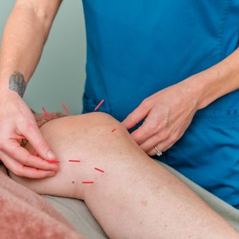 Cairn Clinic - Acupuncture for pain, arthritis and so much more! - Acupuncture Near Me - Bradenton, Florida