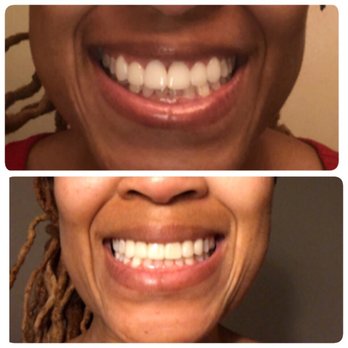 Virginia Dental Group - Veneers redone!   The top pic is Dr. Varga's (work too big and unnatural looking)....the bottom are my new, amazing veneers - General Dentistry Near Me - Fairfax, Virginia