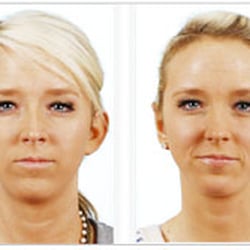 Mobley MD Facial Plastic Surgeon - Otoplasty (ear pinning) Surgery In Utah