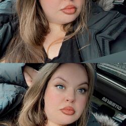 Cosmetiq Medicine - 1 month post lip injections. 1 ml juvederm ultra split between top and bottom lip