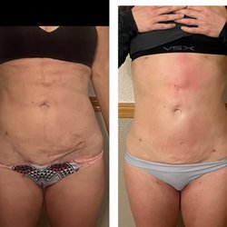 Coeur d'Alene Contour and Wellness  - 4-6 Radio Frequency and cavitation and laser pads. To smooth scars and sculpt her shape .
