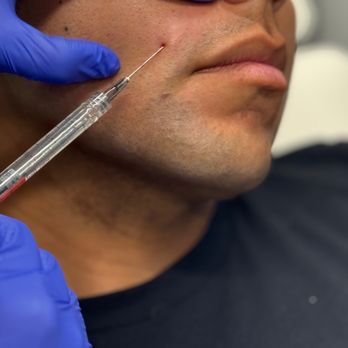Recharge Lab - Nasoloabial Dermal Filler - Medical Spas Near Me - Irvine, California