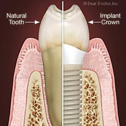Long Island Implant and Cosmetic Dentistry - Implants can restore your mouth and appear completely natural