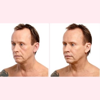 RejuvaMD - Dr. Rouzati offers Botox services across Toronto. - Cosmetic Surgeons Near Me - Toronto, Ontario RejuvaMD - Dr. Rouzati offers Botox services across Toronto. - Cosmetic Surgeons Near Me - Toronto, Ontario