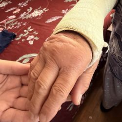 COMSI - Swollen hand due to cast being too tight