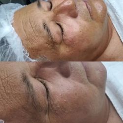 Kalos Spa Center - Facial para hombre, piel deshidratada, y con comedores cerrados y espinillas profundas endurecidas.