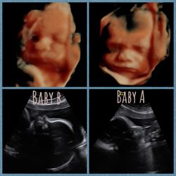 A Future Look 3D4D Ultrasound And Photography - Twin babes 30weeks