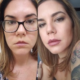 Before and After juvederm so happy with my results! Before and After juvederm so happy with my results!