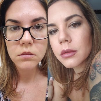 MD Ageless Solutions - Before and After juvederm so happy with my results! - Medical Spas Near Me - Miami, Florida MD Ageless Solutions - Before and After juvederm so happy with my results! - Medical Spas Near Me - Miami, Florida