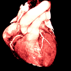 Beverly Hills Cardiovascular - CT Coronary Angiogram