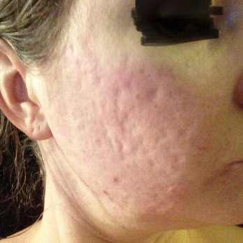 Riviera Laser Studios - Acne scars BEFORE Dr. Kofford - Medical Spas Near Me - Dana Point, California Riviera Laser Studios - Acne scars BEFORE Dr. Kofford - Medical Spas Near Me - Dana Point, California