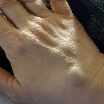 Hartsdale Imaging - Initial photo of the back of my right hand, after MRI with and without contrast showing swelling and bruising. - Diagnostic Imaging Near Me - Hartsdale, New York Hartsdale Imaging - Initial photo of the back of my right hand, after MRI with and without contrast showing swelling and bruising. - Diagnostic Imaging Near Me - Hartsdale, New York