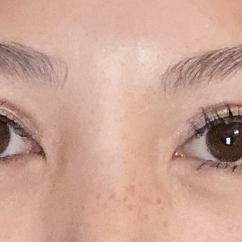 Cheng Plastic Surgery - Post-op 5 weeks - Cosmetic Surgeons Near Me - Saratoga, California