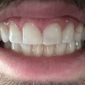 Westside Dental Care - After photo. Fast & excellent quality! - General Dentistry Near Me - Winnetka, California Westside Dental Care - After photo. Fast & excellent quality! - General Dentistry Near Me - Winnetka, California