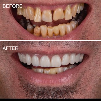 Amsterdam Dental Group - Implants replacing teeth treated in one day - Cosmetic Dentists Near Me - Paoli, Pennsylvania Amsterdam Dental Group - Implants replacing teeth treated in one day - Cosmetic Dentists Near Me - Paoli, Pennsylvania