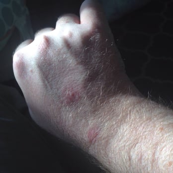 Howard Johnson Hotel - Norwich - More bed bug bites - Hotels Near Me - Norwich, New York Howard Johnson Hotel - Norwich - More bed bug bites - Hotels Near Me - Norwich, New York