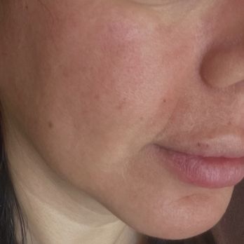 NPMD - Next day after my co2 laser treatment. - IV Hydration Near Me - Encino, California