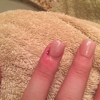 Luxi Nails - These are our infected nails that came from what we believe is the use of not clean instruments! - Nail Salons Near Me - Santee, California Luxi Nails - These are our infected nails that came from what we believe is the use of not clean instruments! - Nail Salons Near Me - Santee, California