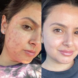 Skin by Janny - Before/after