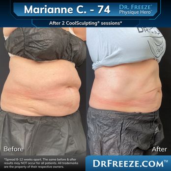 Dr. Freeze CoolSculpting Center - Marianne after 2 CoolSculpting sessions! - Medical Spas Near Me - Palm Desert, California Dr. Freeze CoolSculpting Center - Marianne after 2 CoolSculpting sessions! - Medical Spas Near Me - Palm Desert, California