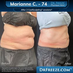 Dr. Freeze CoolSculpting Center - Marianne after 2 CoolSculpting sessions!