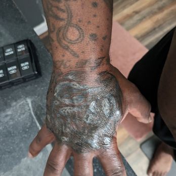Sublime Colorado Body Mod And Tattoo - Deep scars still not healed after a month. - Piercing Near Me - Parker, Colorado Sublime Colorado Body Mod And Tattoo - Deep scars still not healed after a month. - Piercing Near Me - Parker, Colorado