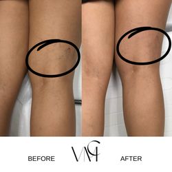 VMC Center for Regenerative Medicine - Spider Vein Removal
