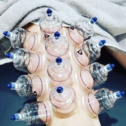 Grasmere Physical Therapy and Rehabilitation - Medical cupping with functional movement.