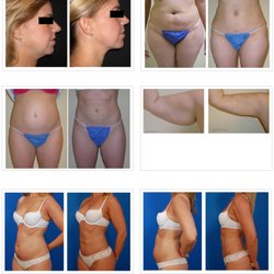 Bloy Richard L MD Facog - SlimLipo
True liposuction in office with local anesthesia!