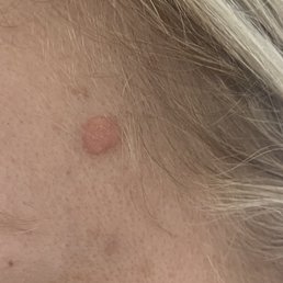 Skin, wisdom spot, Seborrheic keratoses Skin, wisdom spot, Seborrheic keratoses