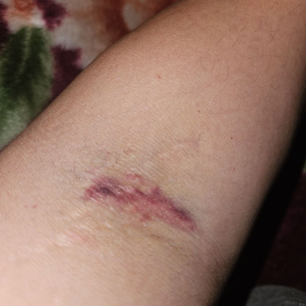 Ouch!!! Ouch!!!