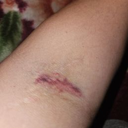 Ouch!!!