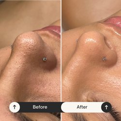Skin Ritualist - Blackhead extractions