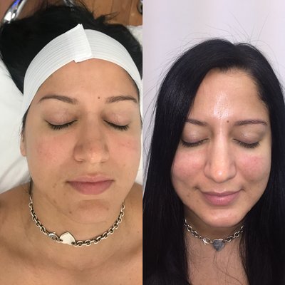 New You Laser by null