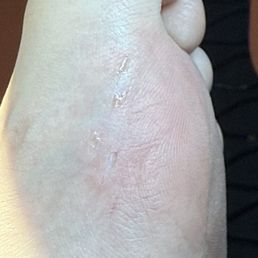 Cut with razor Cut with razor