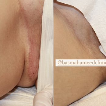 Basma Hameed Clinic - Reconstructive Surgical Scar - Medical Spas Near Me - North York, Ontario Basma Hameed Clinic - Reconstructive Surgical Scar - Medical Spas Near Me - North York, Ontario