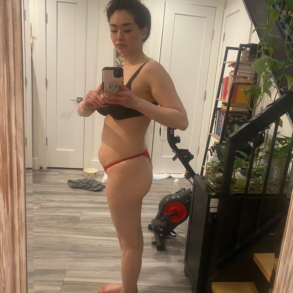 Skinly Aesthetics - Before - 140lbs - Medical Spas Near Me - New York, New York Skinly Aesthetics - Before - 140lbs - Medical Spas Near Me - New York, New York