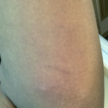 Days Inn by Wyndham Modesto - Bed bug bites - Hotels Near Me - Modesto, California