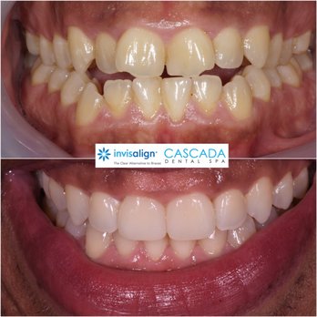 Cascada Dental Spa - DEEP CLEANINGS & INVISALIGN BEFORE & AFTER. THE PROOF IS IN THE PUDDING. - General Dentistry Near Me - New York, New York Cascada Dental Spa - DEEP CLEANINGS & INVISALIGN BEFORE & AFTER. THE PROOF IS IN THE PUDDING. - General Dentistry Near Me - New York, New York