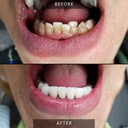 Just Dental - 8 CROWNS