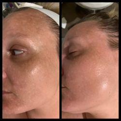 Artistik Image Salon & Spa - Before and After Microdermabrasion Facial!