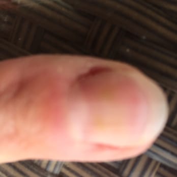 Sparkling Nails & Spa - Fungus still on nail even after nail was almost filed through. - Nail Salons Near Me - Orange, California Sparkling Nails & Spa - Fungus still on nail even after nail was almost filed through. - Nail Salons Near Me - Orange, California