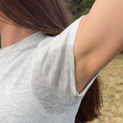 Armpit tox for hyperhydrosis