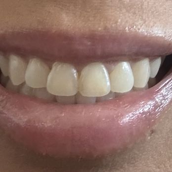 Pure Orthodontics - My teeth after treatment - Orthodontists Near Me - Las Vegas, Nevada Pure Orthodontics - My teeth after treatment - Orthodontists Near Me - Las Vegas, Nevada