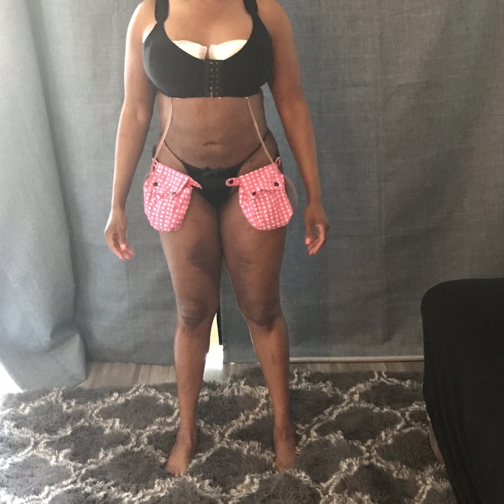 New Life Plastic Surgery - After Wow Thank you Dr. Julio C. Alvarez!!! - Cosmetic Surgeons Near Me - Miami, Florida New Life Plastic Surgery - After Wow Thank you Dr. Julio C. Alvarez!!! - Cosmetic Surgeons Near Me - Miami, Florida
