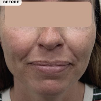 Concierge Aesthetics - Before my coolpeel- so much sun damage!!!! - Medical Spas Near Me - Irvine, California
