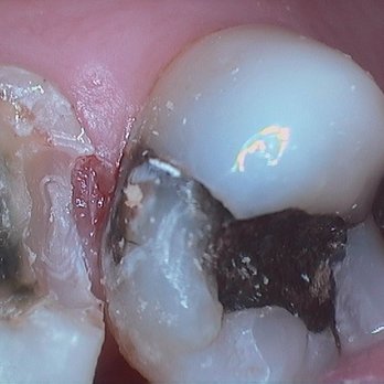 Ideal Dentistry - Before photo - General Dentistry Near Me - Peoria, Arizona
